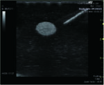 Ultrasound Guided Breast Biopsy Training Model - Duo (Transparent and Opaque) set US-9 - Image 2