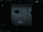 Ultrasound Guided Breast Biopsy Training Model - Duo (Transparent and Opaque) set US-9 - Image 7